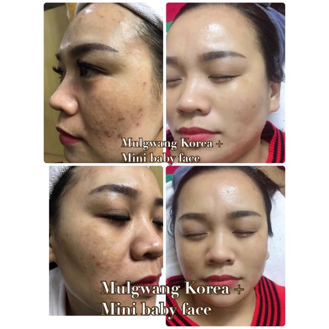 TẾ BÀO GỐC MULGWANG CĂNG BÓNG ĐẦY SẸO MẪU MỚI 2019
