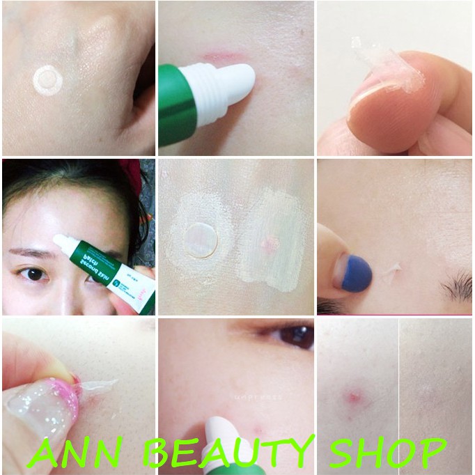 Gel Dán Mụn Second Skin Patch 10ML (date 9/2022) | BigBuy360 - bigbuy360.vn