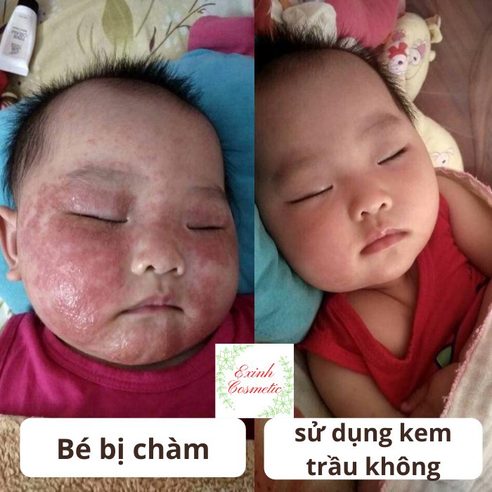 [CHÍNH HÃNG] KEM TRẦU KHÔNG PIZKIE CREAM - CHUYÊN TRỊ CHÀM CHO BÉ (30g)