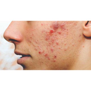 Combo 5 Thanh Xà Phòng Sebamed pH5.5 [Nhập Khẩu Chính Hãng]