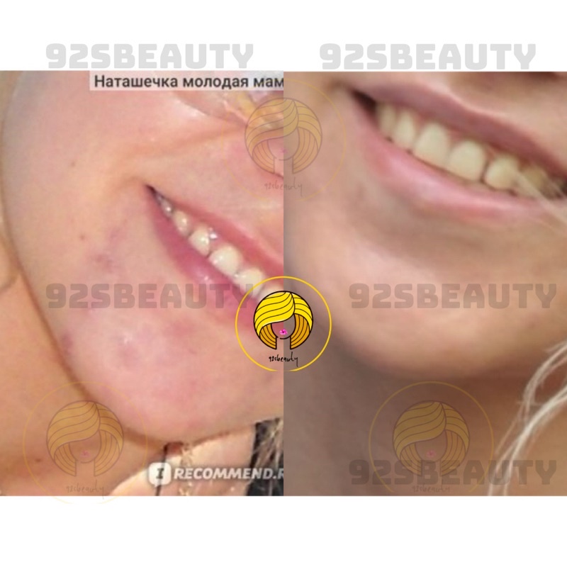 Gel BHA chấm mụn Compliment không chứa cồn giúp giảm mụn hiệu quả | BigBuy360 - bigbuy360.vn