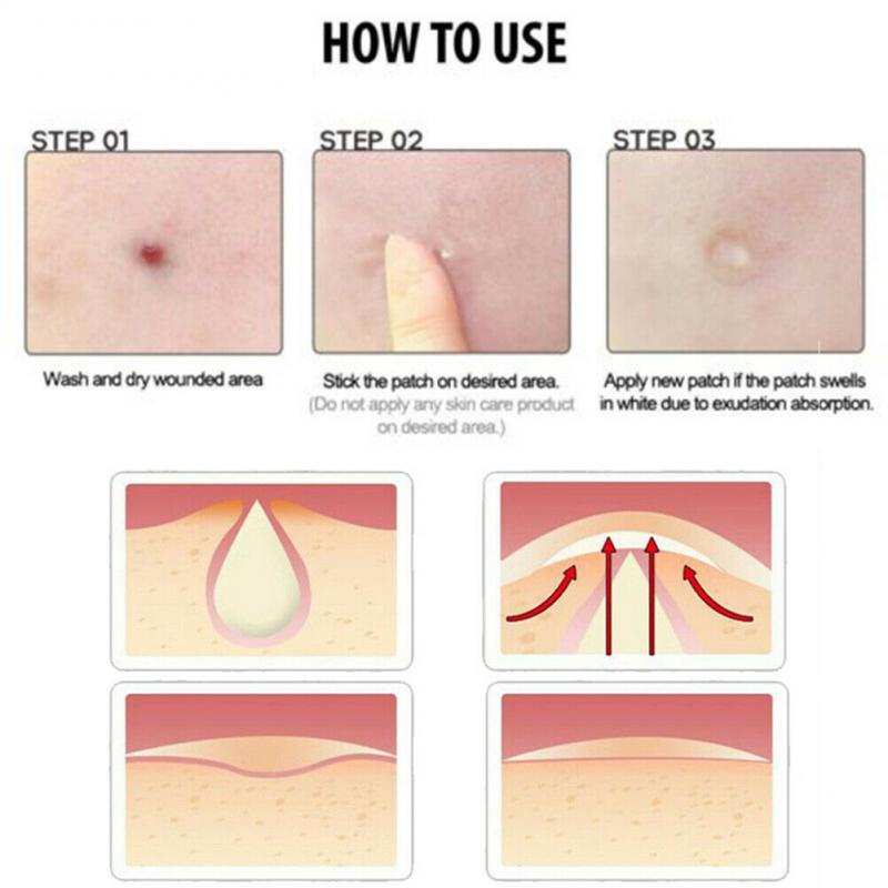 Set 36 Miếng Dán Hỗ Trợ Giảm Mụn Hydrocolloid Vô Hình Chăm Sóc Da
