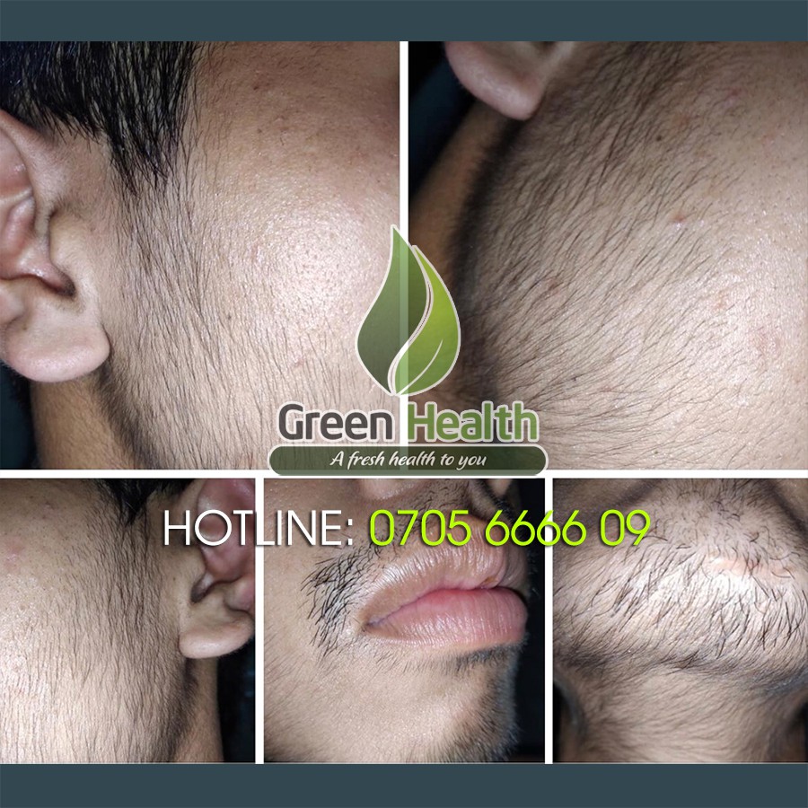 Hộp 6 chai Minoxidil 5% dạng BỌT  mọc râu tóc