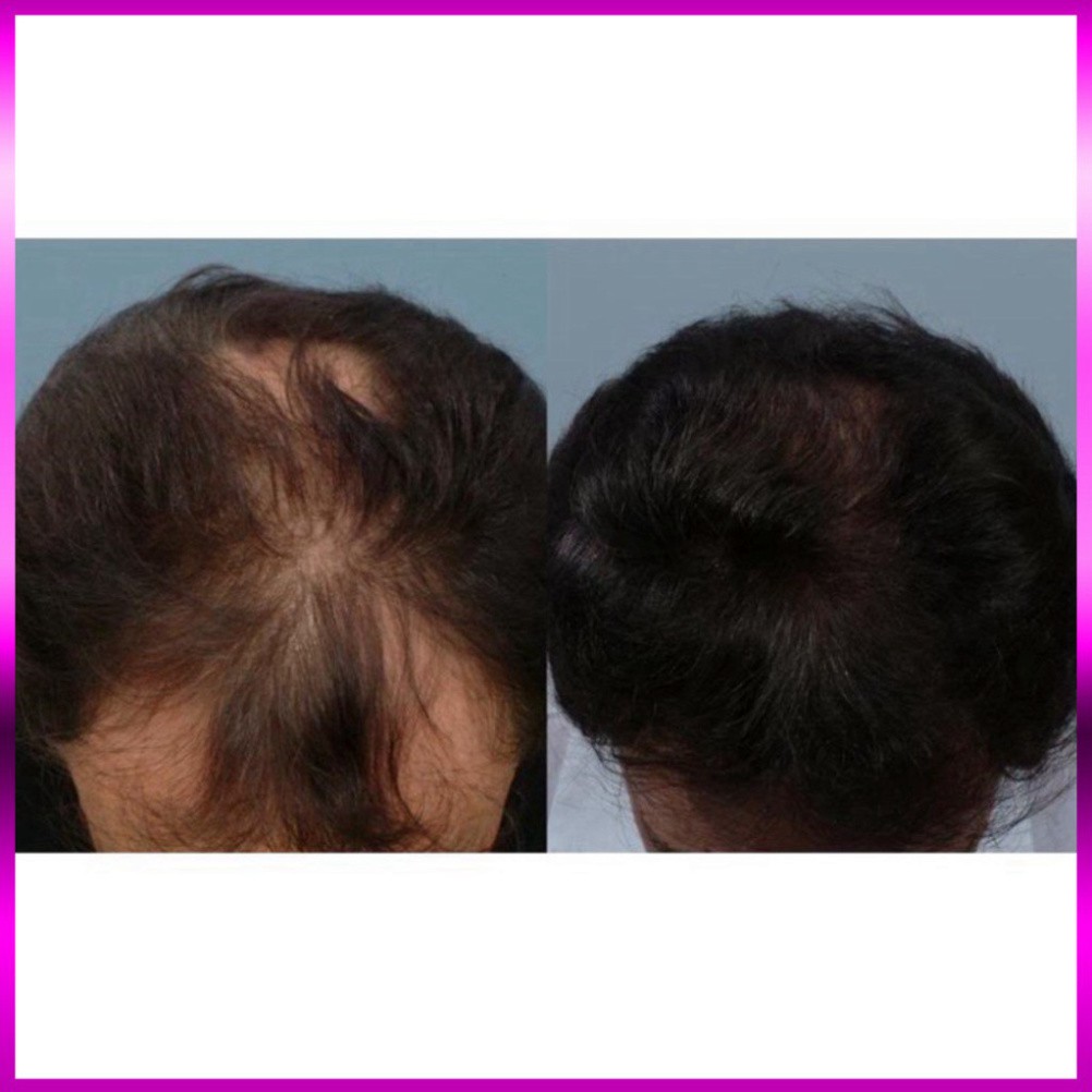 GIÁ CỰC ĐÃ Viên uống hỗ trợ mọc tóc Biotin 10,000mcg - Dùng kèm Minoxidil GIÁ CỰC ĐÃ