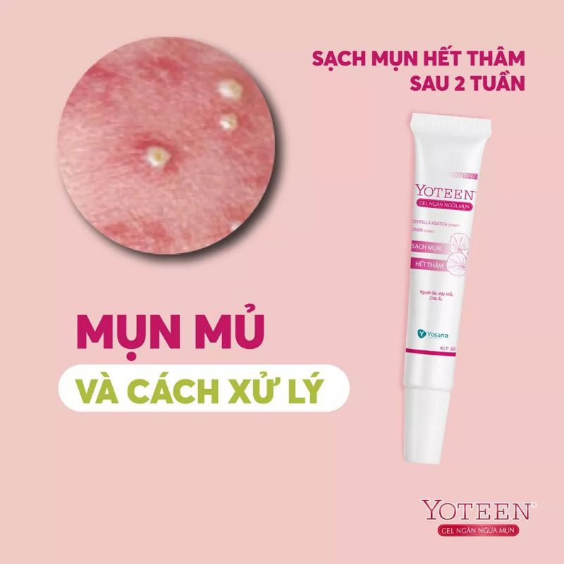 YOTEEN Gel ngăn ngừa mụn,chống viêm ,cung cấp độ ẩm cho da