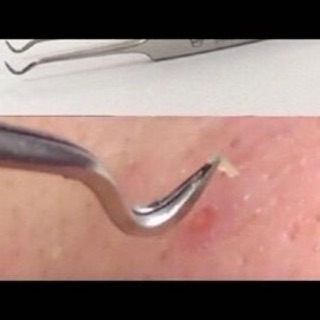 Dụng cụ nhíp lấy mụn _Vetus