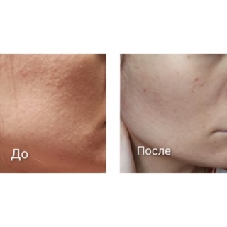 SERUM EVELINE GLYCOL 5% SÁNG DA GIẢM MỤN (B3+VitC)