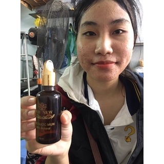 Serum thảo dược mụn may new tái tạo da