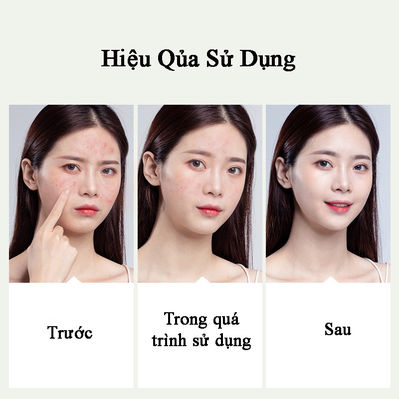 Kem dưỡng làm mờ thâm mụn dàn cho da mụn Acne Cream Maycreate Senabeauty | BigBuy360 - bigbuy360.vn