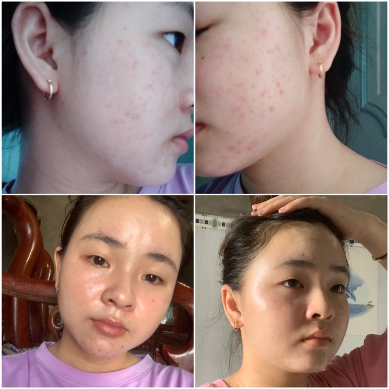 Sắc Hồng ngừa mụn - mờ nám - giúp đều màu da