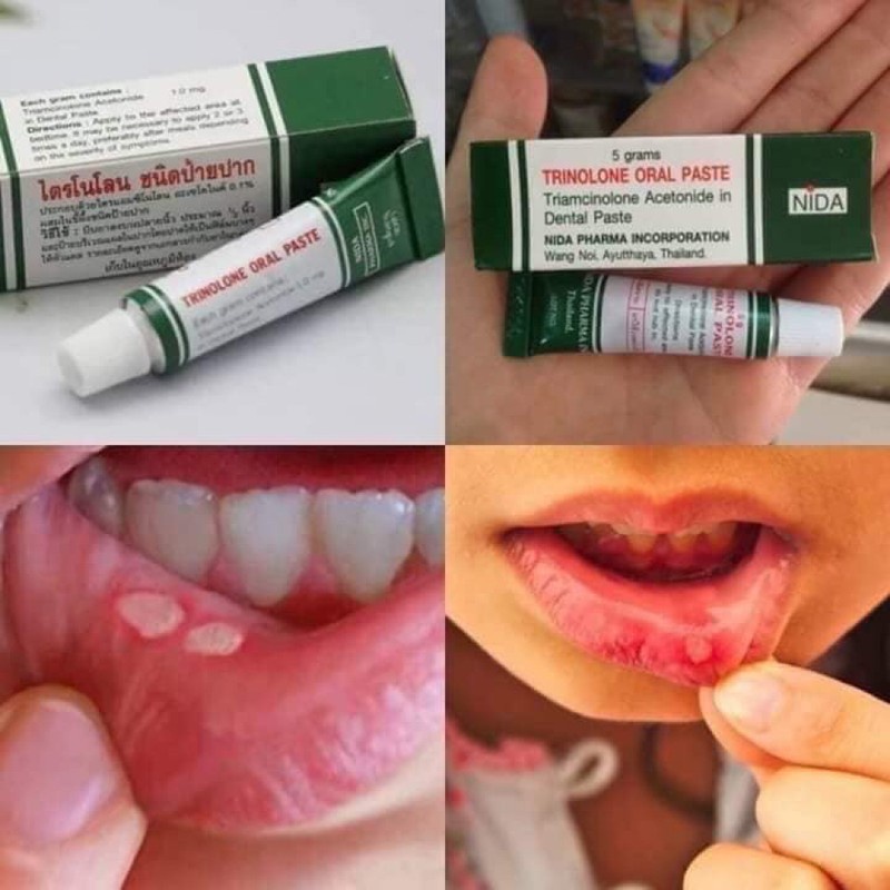 Kem nhiệt miệng Trinolone Oral Paste 5g Thái Lan