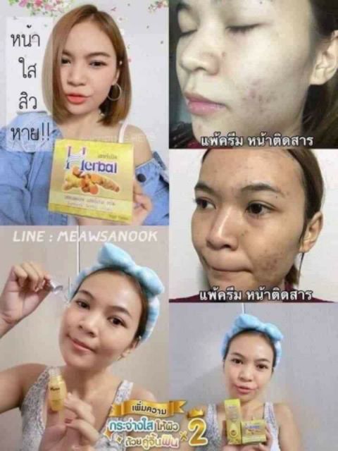 Kem nghệ HERBAL THÁI LAN