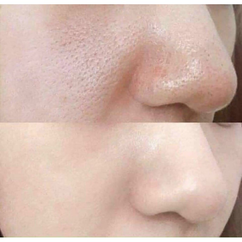 Tế bào gốc giảm lỗ chân lông pocia lọ 10ml