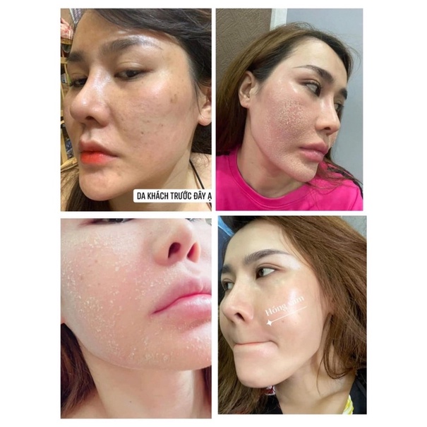 TÁI TẠO HỒNG SÂM