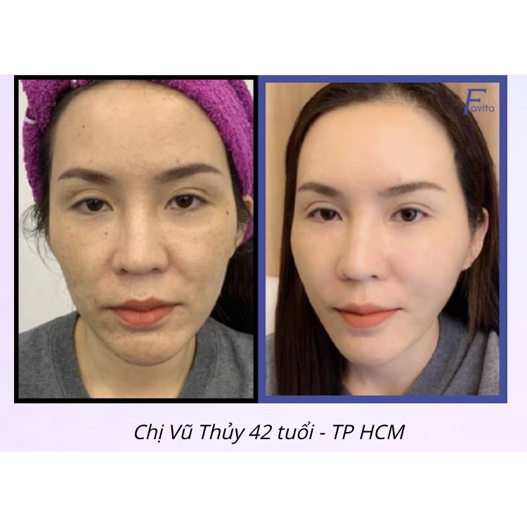 FAVITA PLUS đột phá trẻ hóa làn da chỉ sau vài tuần, loại bỏ nám, tàn nhang, làm mờ nếp nhăn, chống lão hóa da