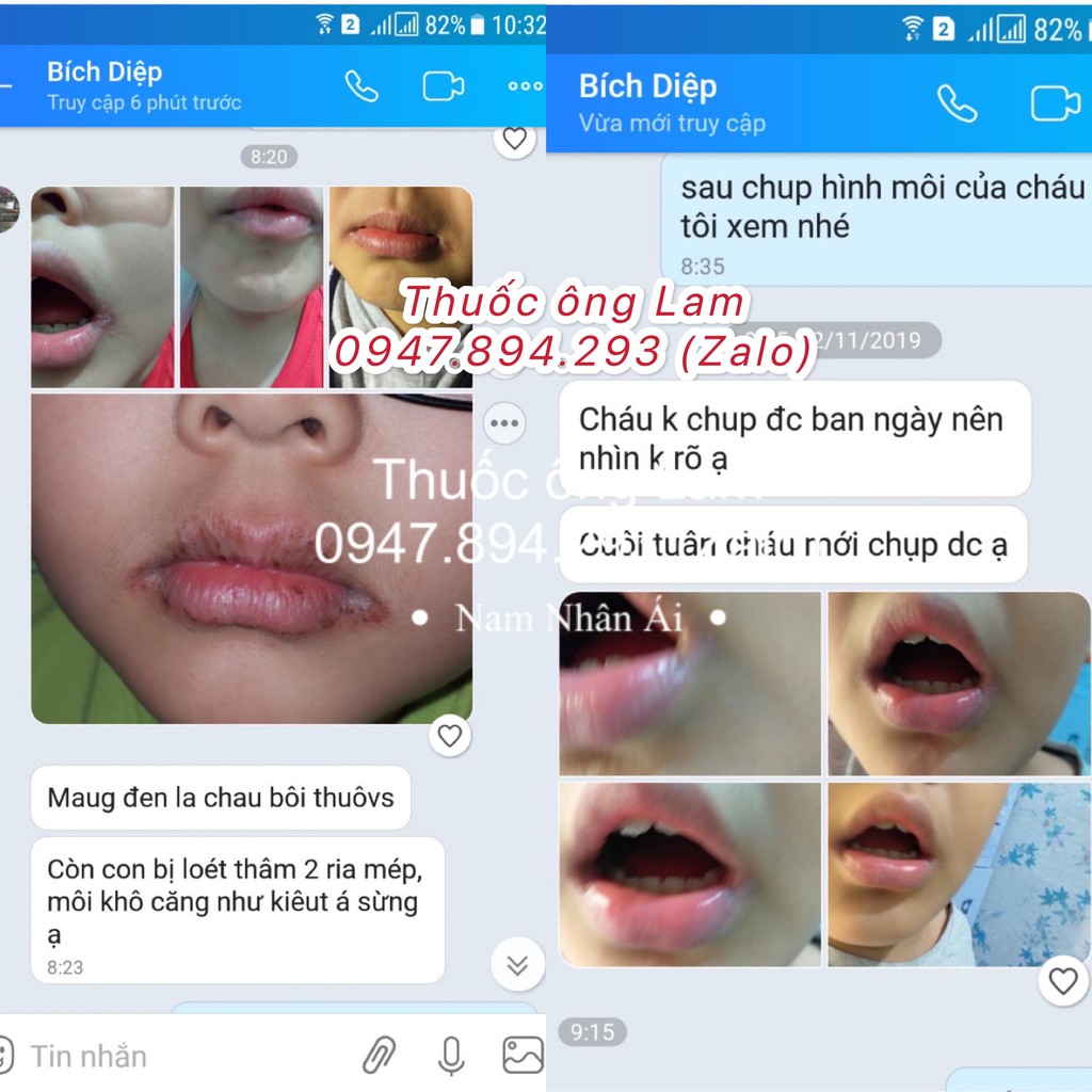 Tổ đỉa, chàm, chàm sữa, mẩn ngứa, cơ địa Ông Lam | BigBuy360 - bigbuy360.vn