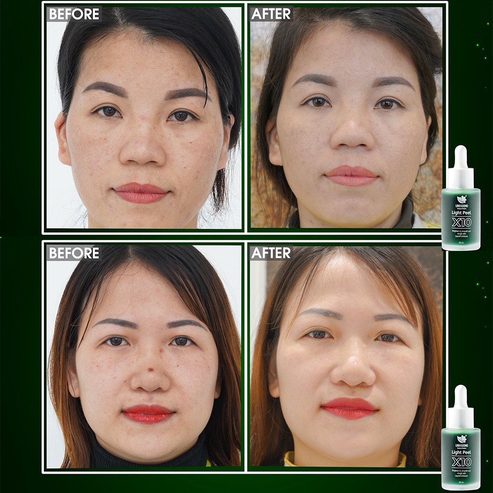 Thay Da Sinh Học Linh Hương, Peel Da,  Light Peel X10 làm trắng da, tái tạo làn da mới, thay da tại nhà