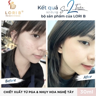 KEM MỤN THẢO DƯỢC LORIB (MẪU MỚI)