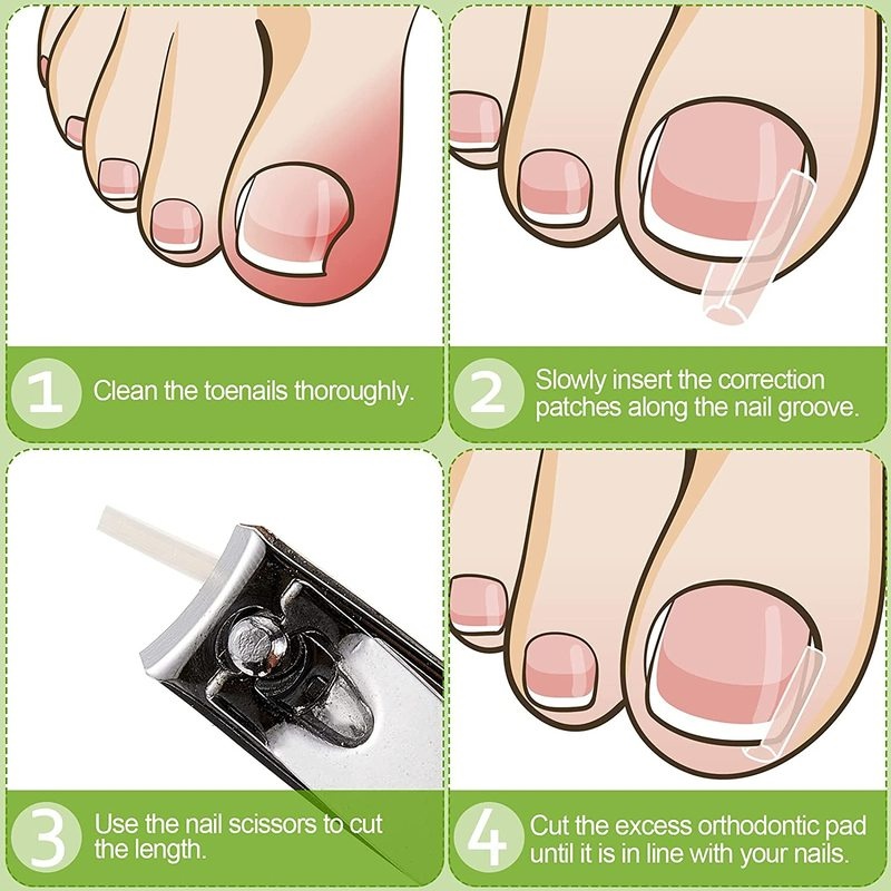 Miếng Đệm Lót Chỉnh Hình Làm Thẳng Móng Chân Tiện Dụng