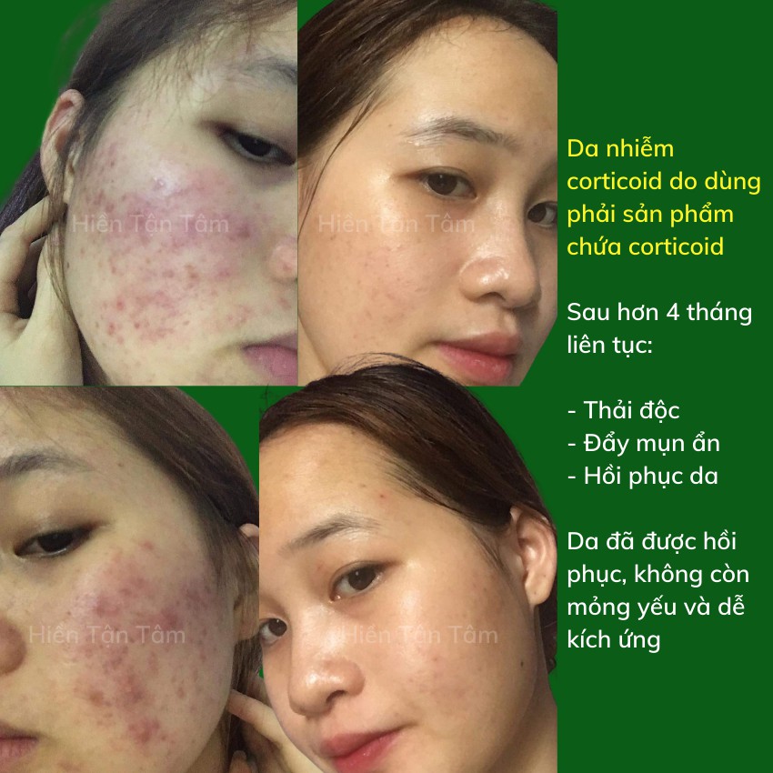 Lá Nam 2 In 1 Organic Detox & Peeling - Thải độc cho da nhiễm corticoid, tẩy da chết, tắm trắng da - Lá Nam Acnes