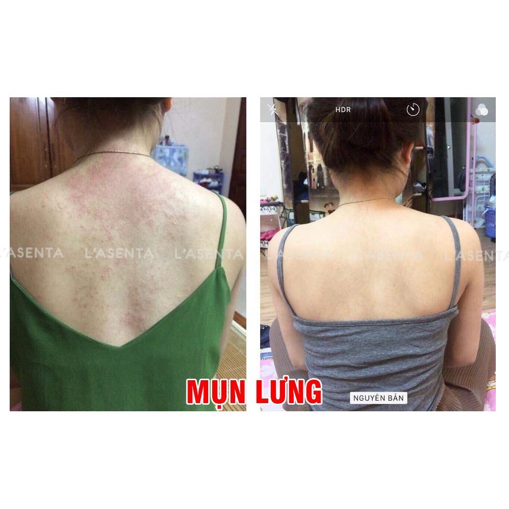 Muối Tắm Tinh Chất Sữa Non Lasenta Hết Mụn Lưng, Viêm Nang Lông