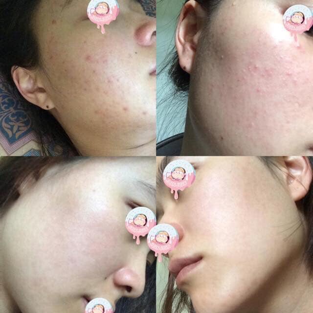 [MẪU MỚI] SERUM MỤN DETOX BLANC MỚI NHẤT GIẢM MỤN HIỆU QUẢ | BigBuy360 - bigbuy360.vn