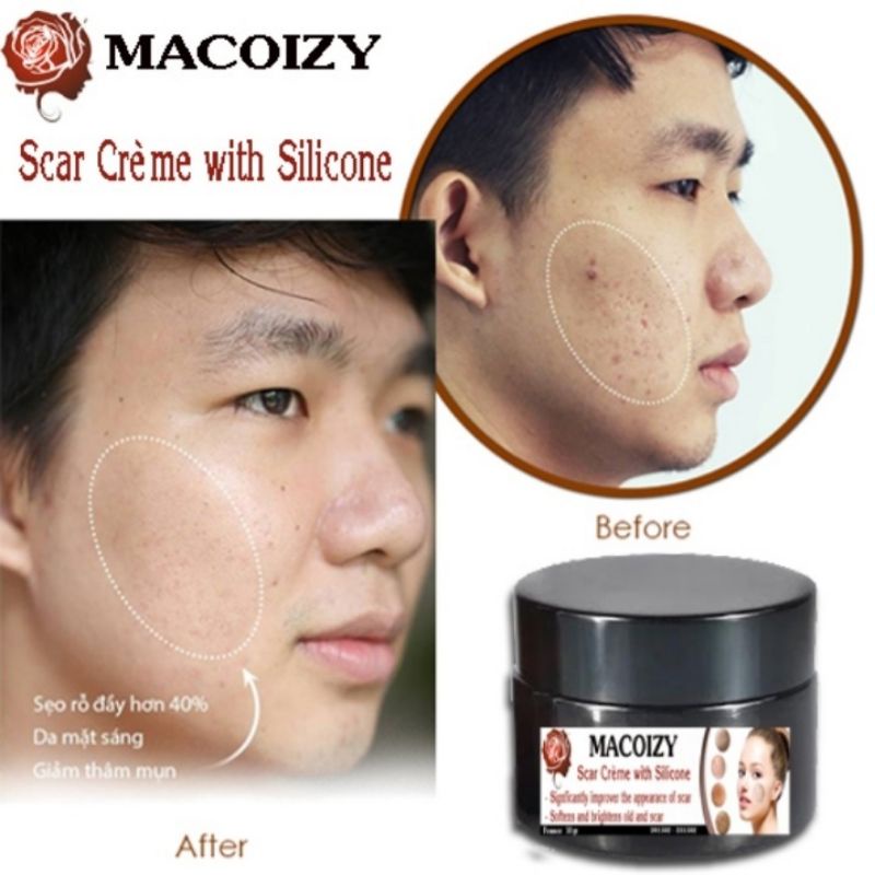 Combo serum Macoizy & Kem Xóa Sẹo rỗ