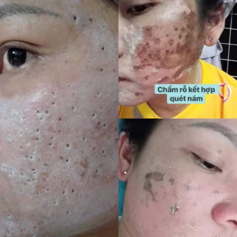 💥💥Chấm nám chân sâu,sẹo rỗ đức thịnh handmade 1ml | BigBuy360 - bigbuy360.vn