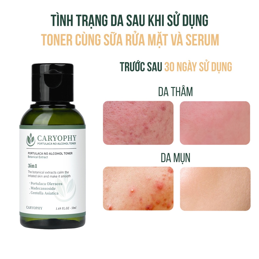 Bộ chăm sóc da mụn Caryophy Portulaca (Tẩy trang 60ml Toner 50ml Serum 10ml KCN 5ml)