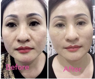 Chỉ căng da trẻ hoá xoá nhăn mặt- 50 sợi/ gói