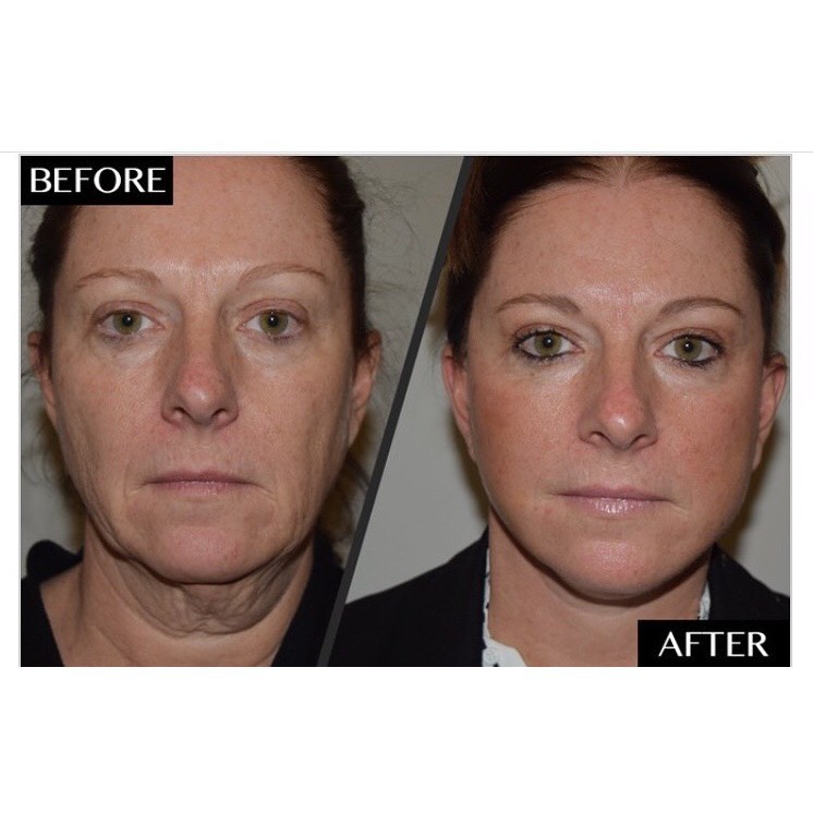 Big Gel 60 Cặp Facial Galvanic Nuskin