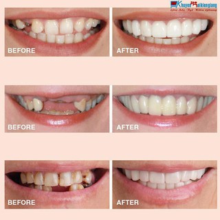 Dụng cụ niềng răng tại nhà snapon smile - nẹp răng tại nhà