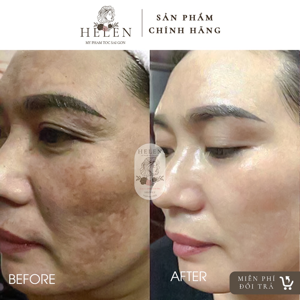 Peel GSH MCCM & MCCOSMETIC Tái tạo giúp trắng sáng da-Tạm biệt nám