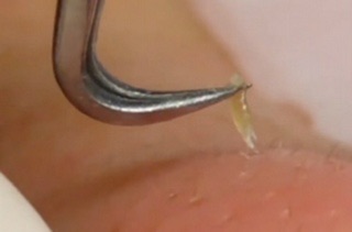 Nhíp gắp mụn siêu nhanh