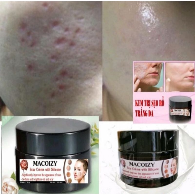 Kem Xóa Sẹo Rỗ MACOIZY Dưỡng Trắng Hết Thâm