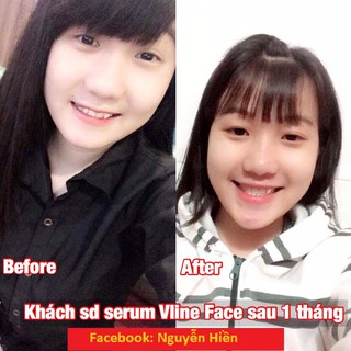 Tinh Chất Thon Gọn Mặt V-line Pháp