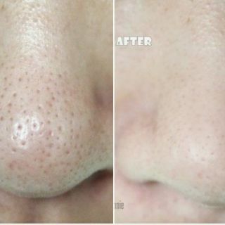 🇺🇸🇺🇸Ủ MỤN ĐẦU ĐEN ĐẦU TRẮNG SUPER X LOTION