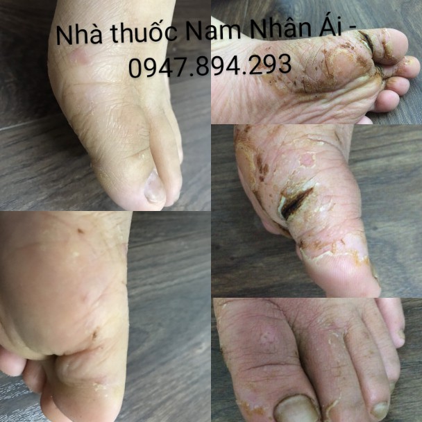 Tổ đỉa, chàm, chàm sữa, mẩn ngứa, cơ địa Ông Lam | BigBuy360 - bigbuy360.vn