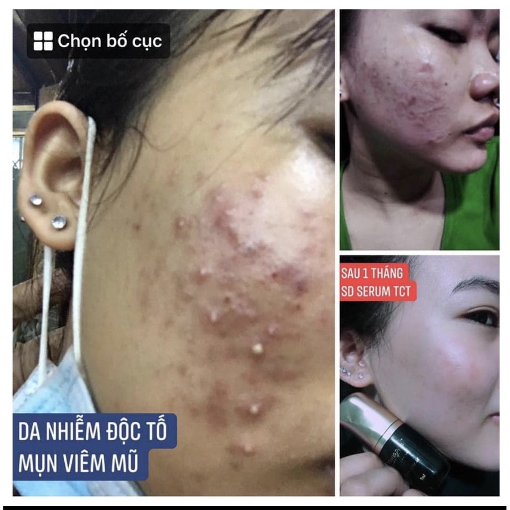 SERUM TRỨNG CÁ TUYẾT Dermapeel+ - XÓA MỤN - Mờ THÂM MỤN - Se Khít LCL - DA CĂNG BÓNG - TRẮNG SÁNG SAU 14 NGÀY | BigBuy360 - bigbuy360.vn