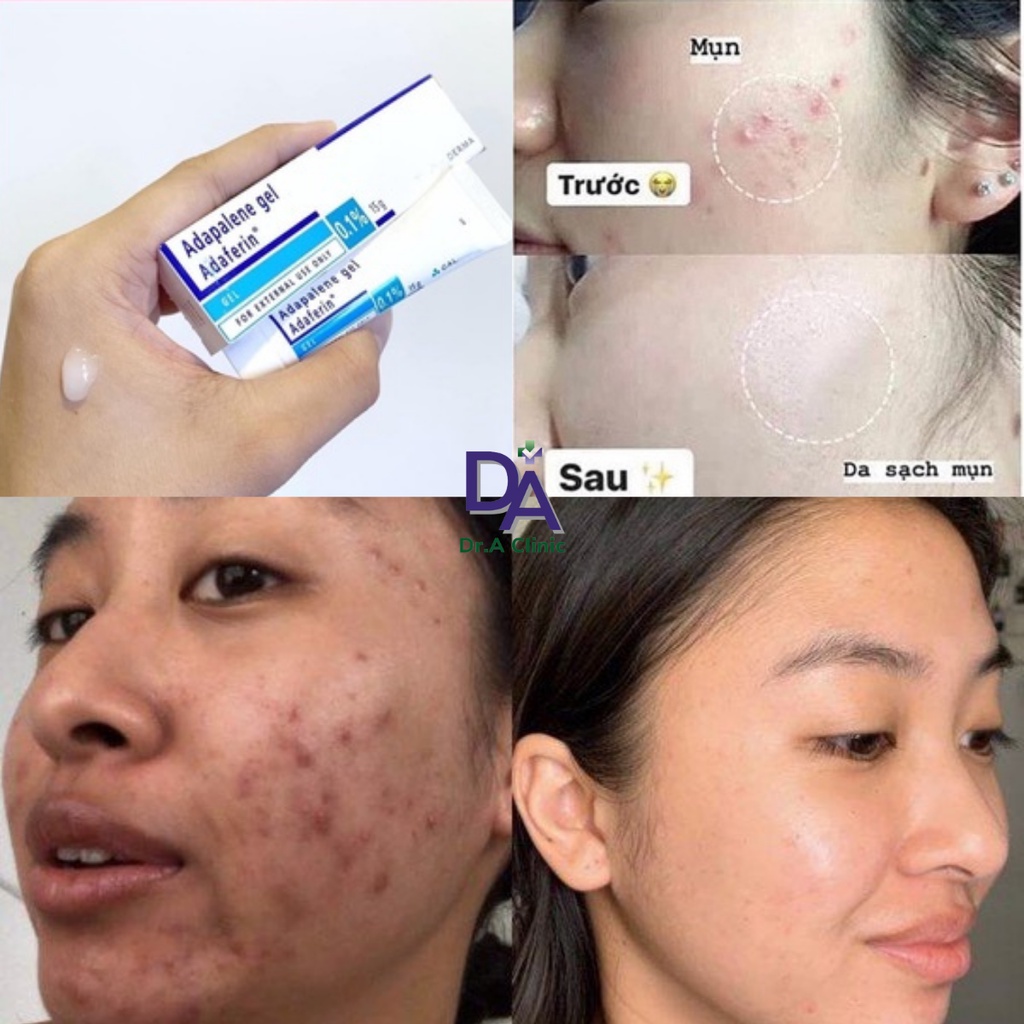 Adapalene Gel 0.1 Adaferin Chính Hãng giúp giảm mụn ẩn mụn trứng cá mụn đầu đen hiệu quả GIBE COSMETICS