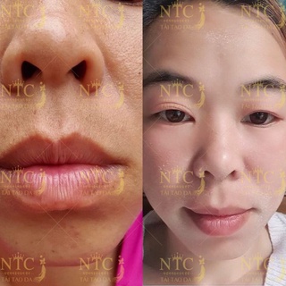 tái tạo da nhanh NTC