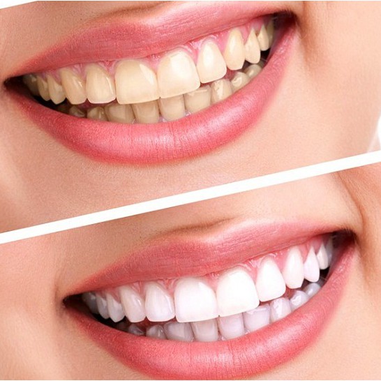 TẨY TRẮNG TẠI NHÀ POLA NIGHT 22% - HÀNG CHÍNH HÃNG