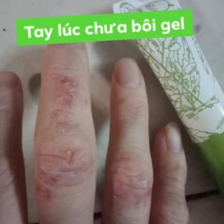 Gel bôi da Phú KANG