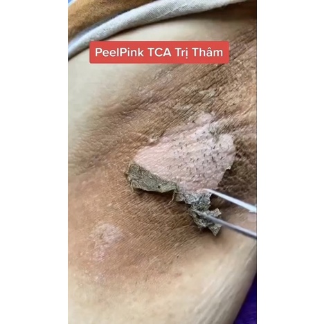 PEEL TCA TRIỆT THÂM NÁCH