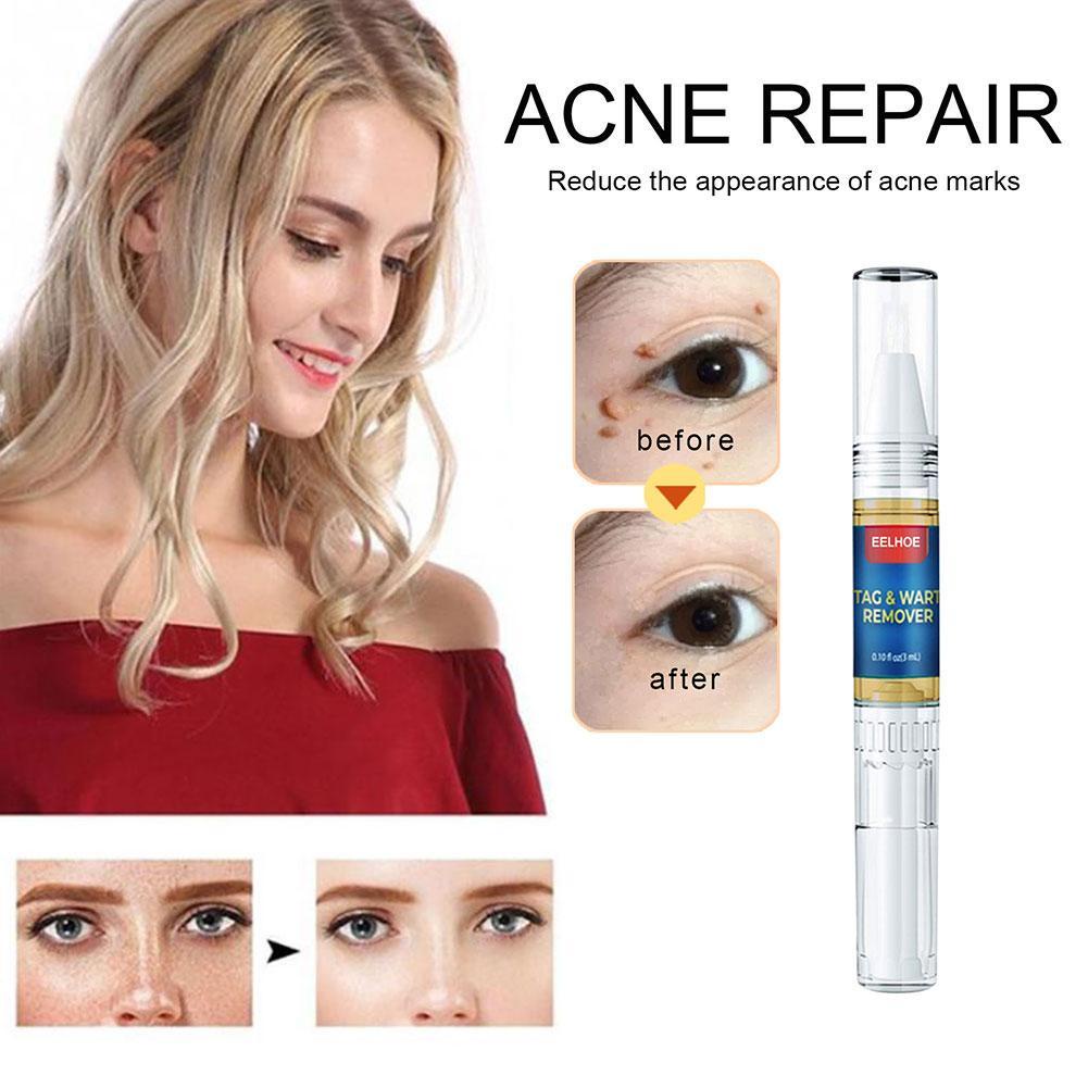 Bút Tẩy Nốt Ruồi Và Mụn Đầu Đen Làm Mịn Da P6I5