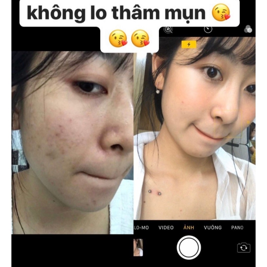 Serum mụn Secret Life🌸FREE SHIP🌸Ngăn Ngừa Mụn, Dưỡng Da, Se Lỗ Chân Lông, Sáng và Làm Đều Màu Da