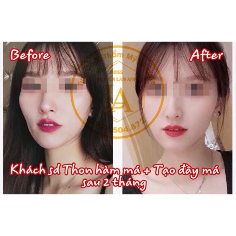 Tinh chất Mircale Pháp làm đầy má, tạo má baby chỉ sau 1 tháng(10ml)