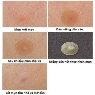 Miếng Dán Mụn Cấp Tốc Mayan Care