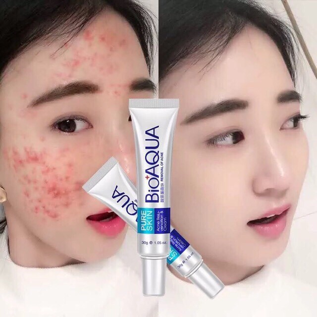 Kem Mụn Bioaqua Pure Skin Hàng Nội Địa Trung MXx