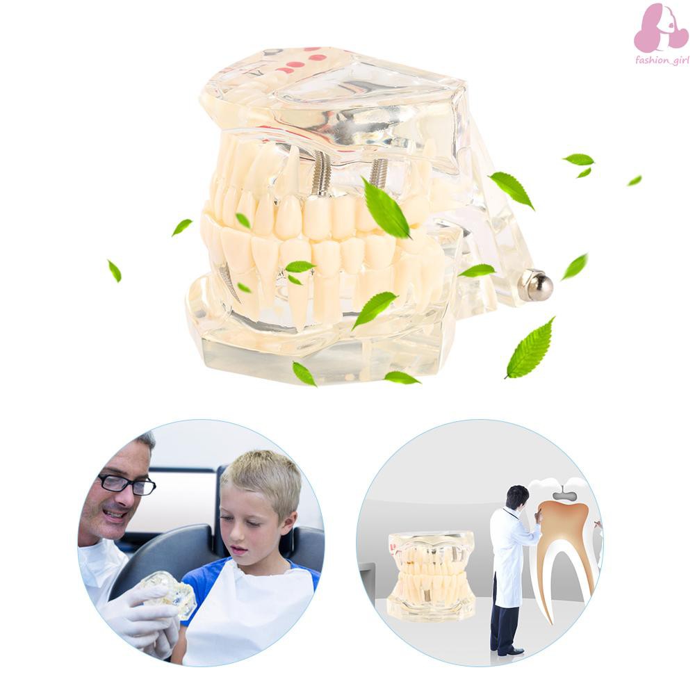 Mô hình hàm răng trong suốt dạy học việc cấy răng có thể tháo rời cho nha khoa